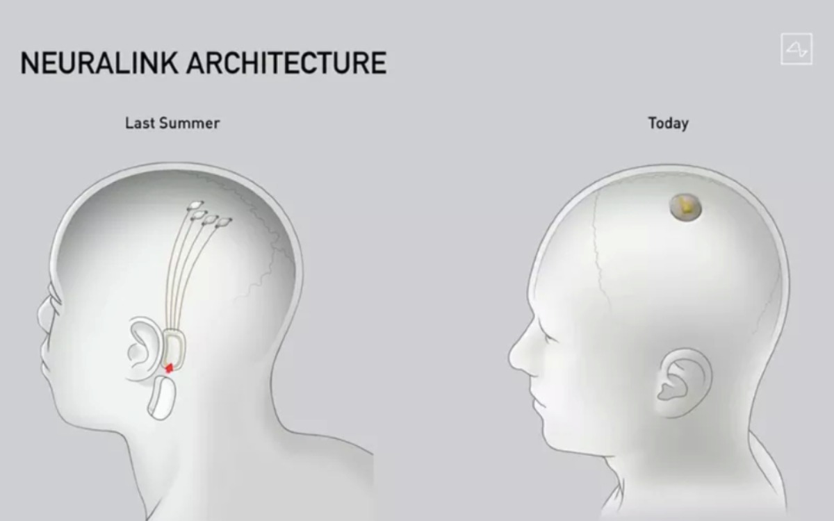 Cultura el inicio de los implantes neuronales 4