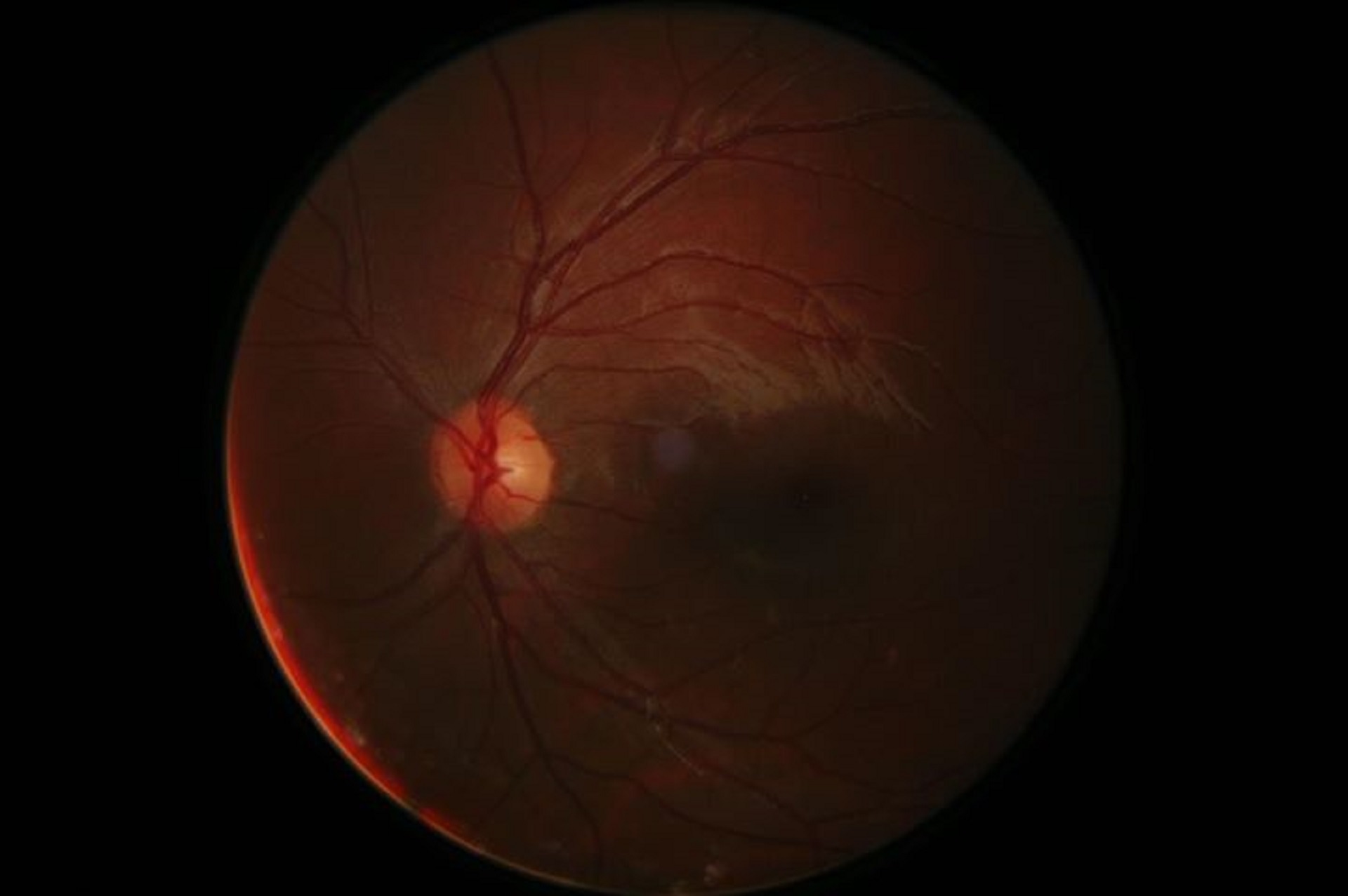 Ciencia efectuaron el primer trasplante de ojo humano completo 2