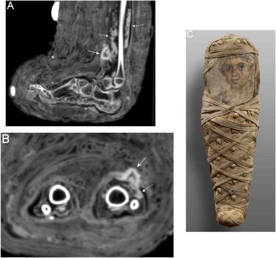 Cultura el hallazgo de la momia egipcia de un infante 2