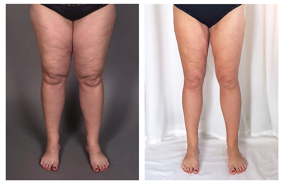 Ciencia lipedema y celulitis 2