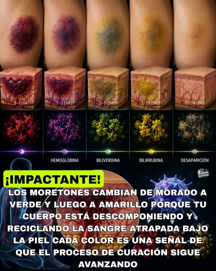 🚨🟣🟢🟡😳 LOS MORETONES CAMBIAN DE COLOR PORQUE TU CUERPO ESTÁ DESCOMPONIENDO LA SANGRE ATRAPADA BAJO LA PIEL