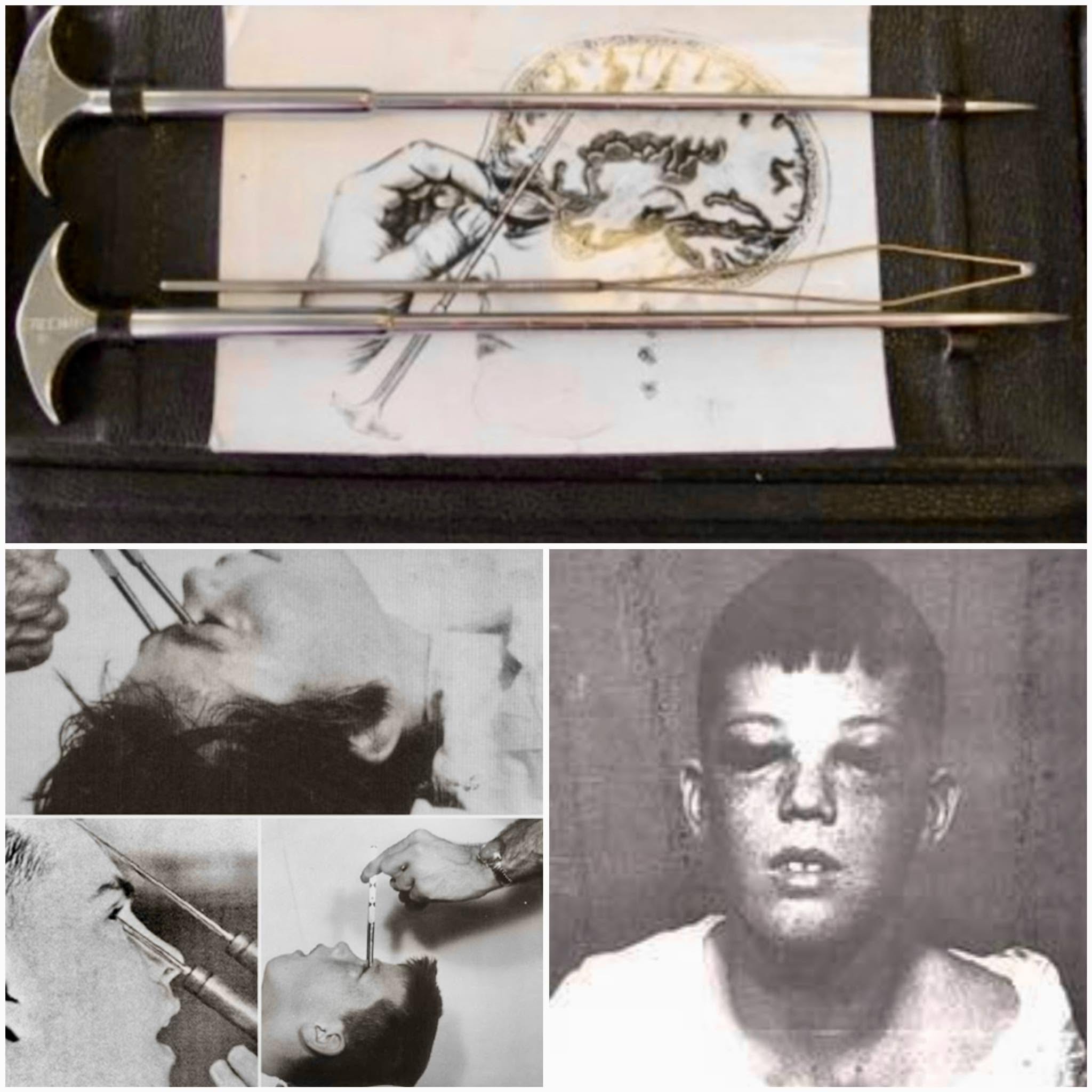 Howard Dully representa una de las historias más impactantes sobre los peligros de la lobotomía, un procedimiento neuroquirúrgico que consistía en...