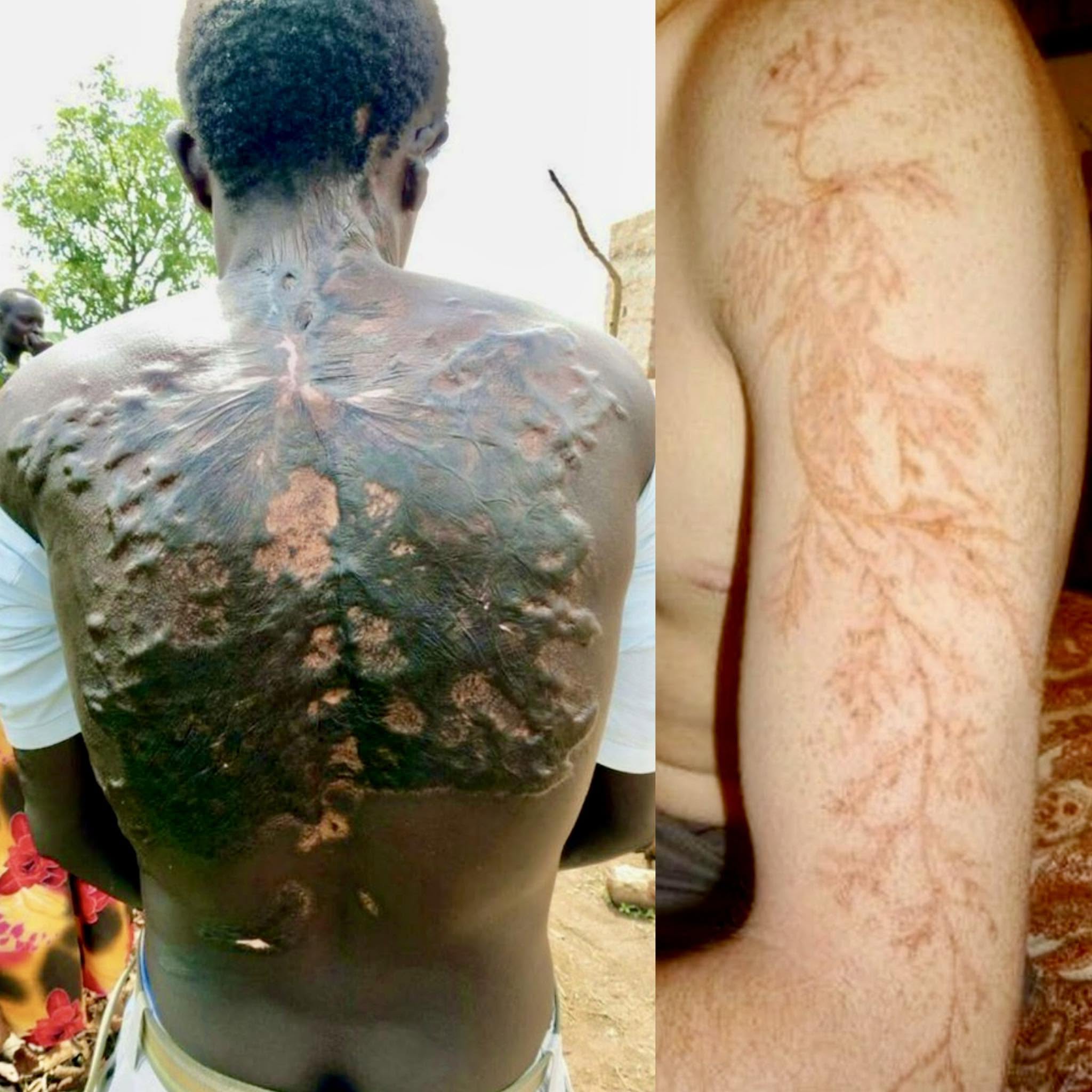Las figuras de Lichtenberg, también conocidas como "flores de rayos", son cicatrices en forma de raíz que aparecen en la piel de quienes han sido al...