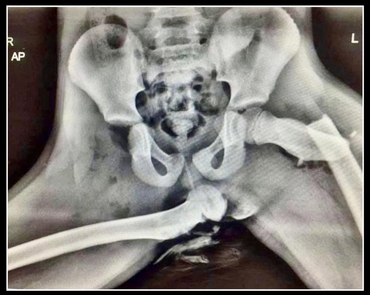 Es fundamental no colocar los pies en el salpicadero del automóvil, como se evidencia en la radiografía de un pasajero del asiento delantero que suf...