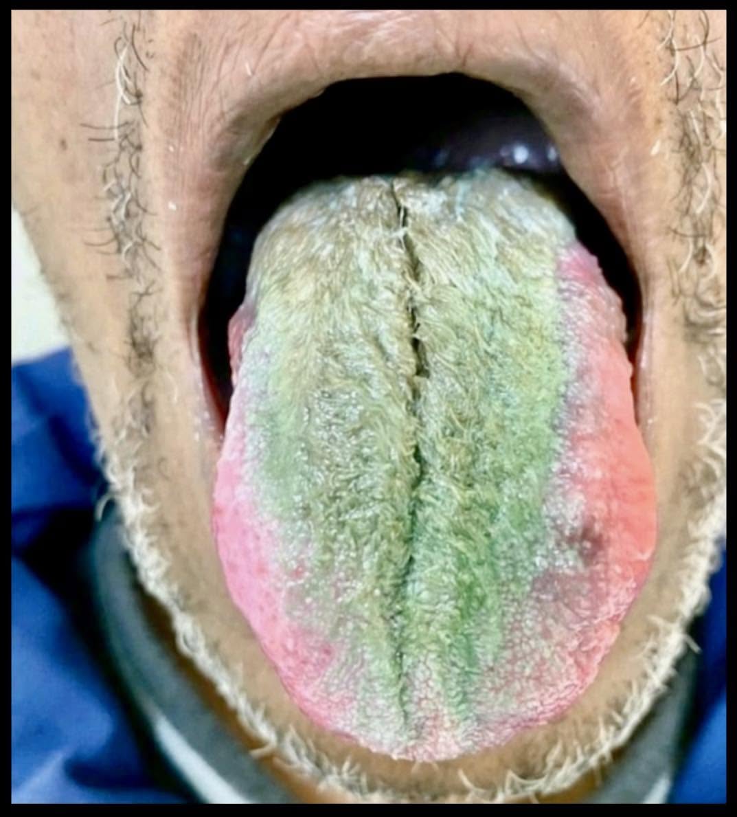 La imagen de esta extraña lengua peluda pertenece a un hombre de 64 años, fumador empedernido, que desarrolló esta peculiar condición