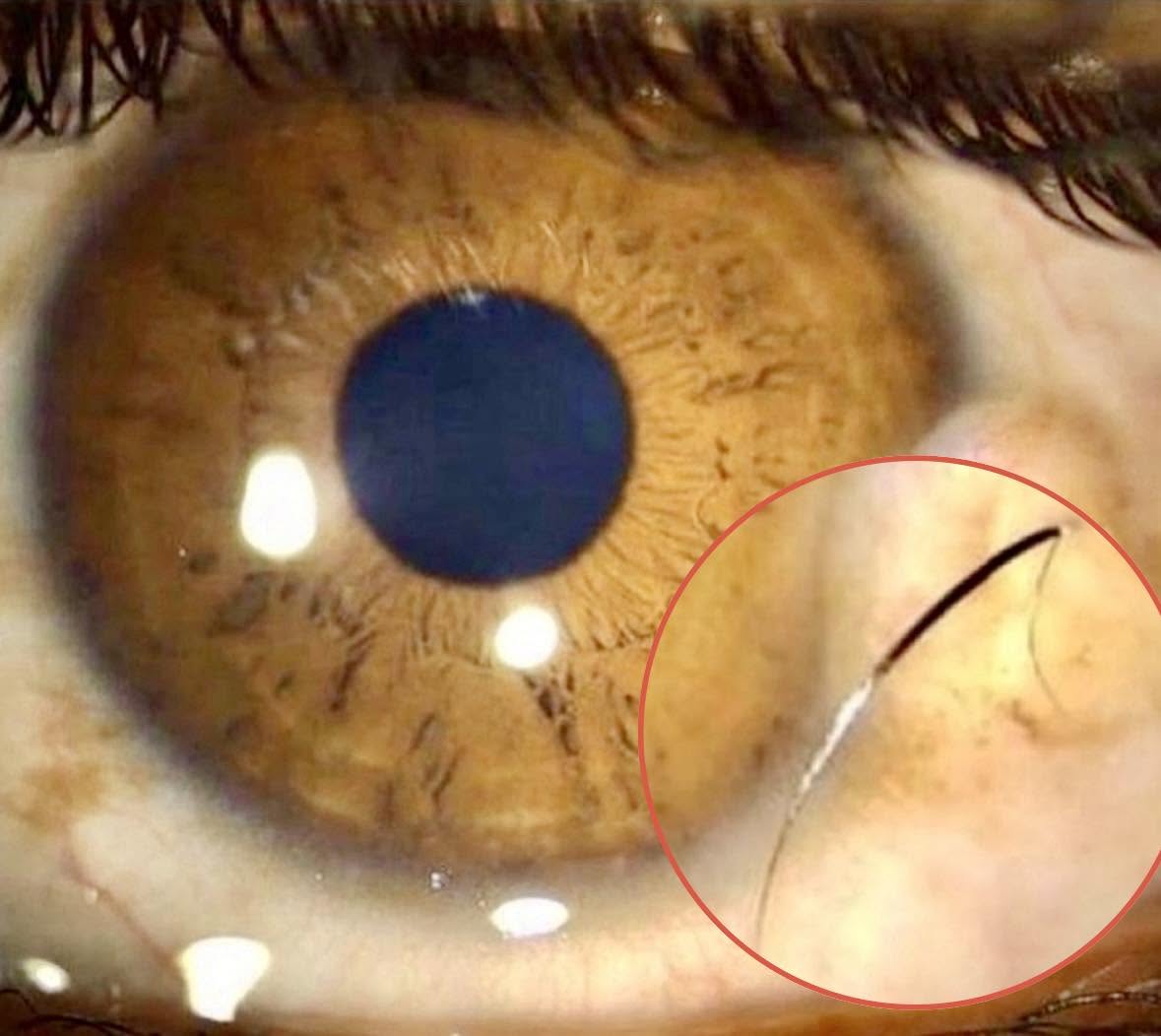 Un adolescente se presentó con un bulto creciente en su ojo derecho, el cual había estado presente desde su infancia