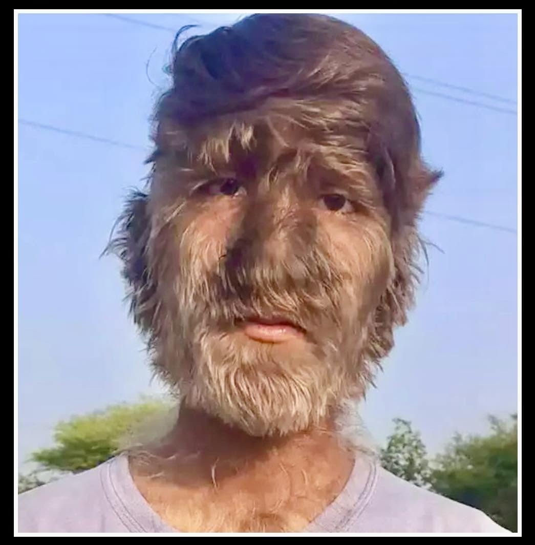 En un pequeño pueblo de Madhya Pradesh, India, vive Lalit Patidar, un niño que enfrenta un desafío extraordinario: sufre de hipertricosis, una rara...