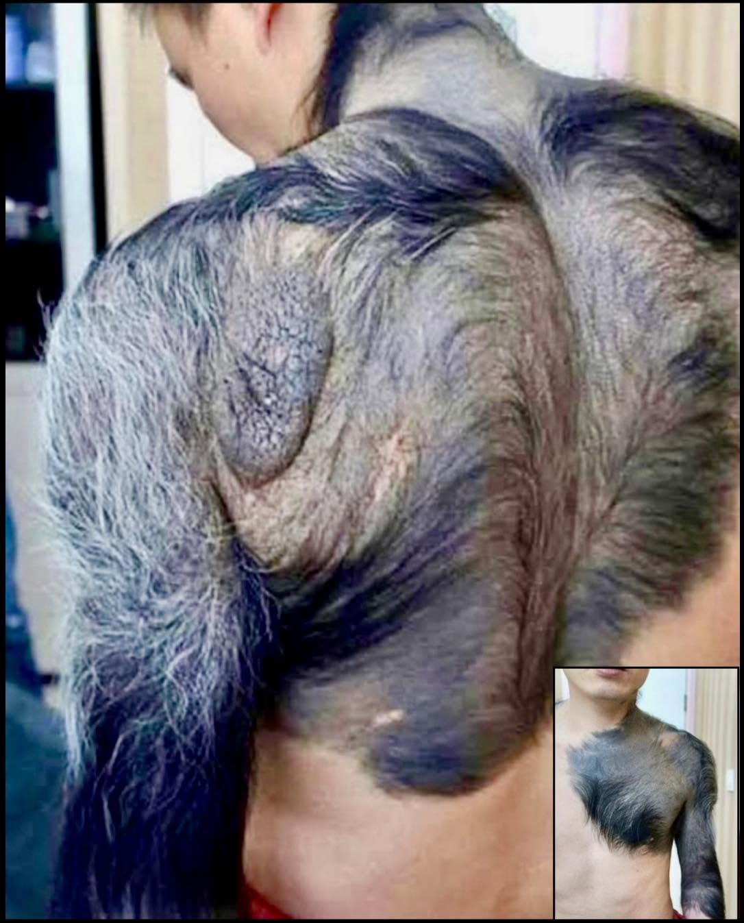 Zhang Hongming es una figura emblemática en el ámbito de las condiciones médicas raras, conocido por vivir con un nevus pigmentado gigante