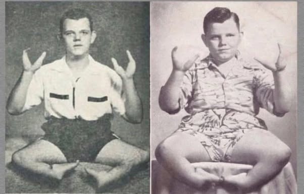 El hombre al que llamaban “Lobster Boy”