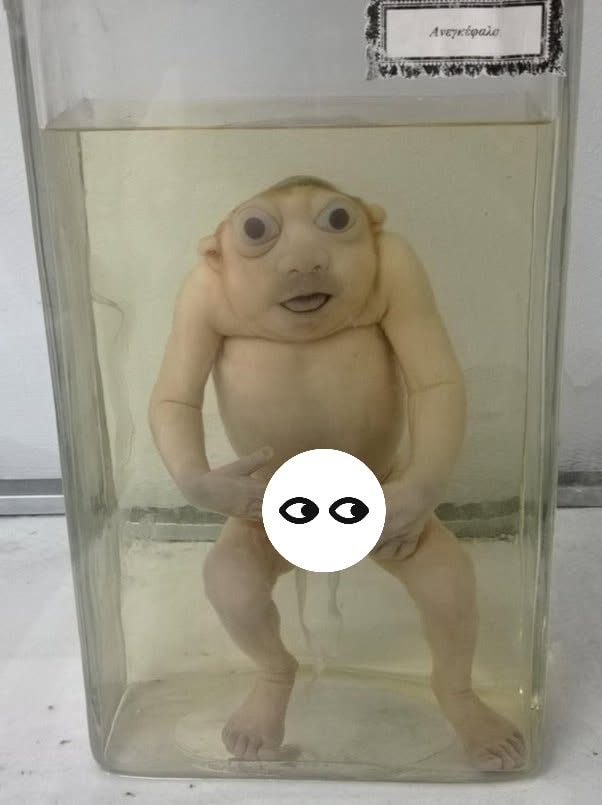 La anencefalia es una malformación congénita grave que ocurre cuando el tubo neural no se cierra correctamente durante las primeras semanas del desa...