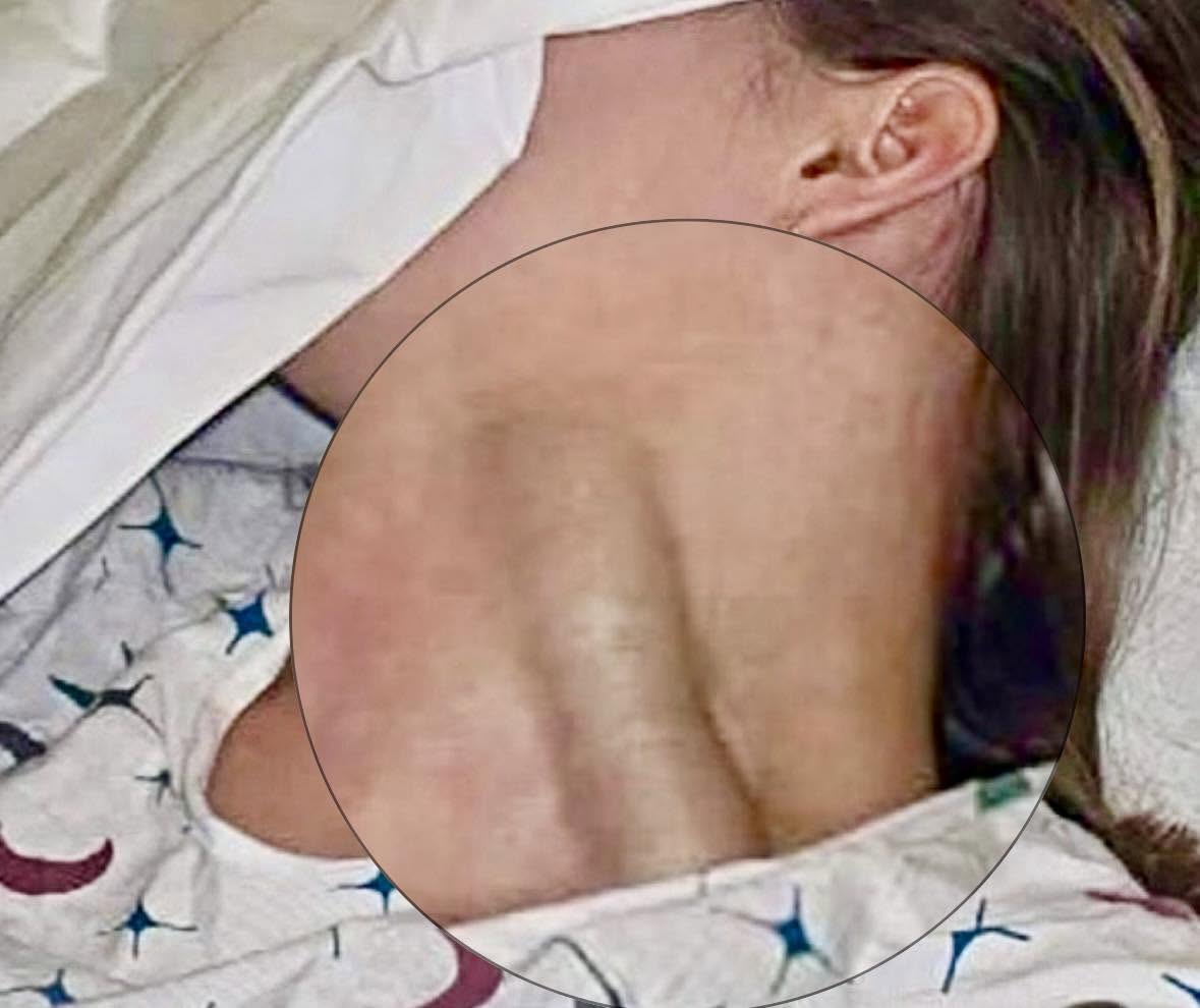 La siguiente imagen muestra la vena yugular de forma distendida