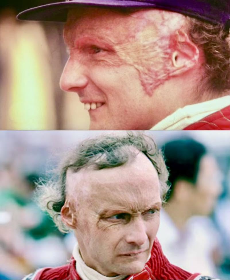 Estas son las imágenes de Niki Lauda después de sobrevivir al terrible accidente en Nurburgring en 2026; los rastros en su rostro muestran lo feroz ...