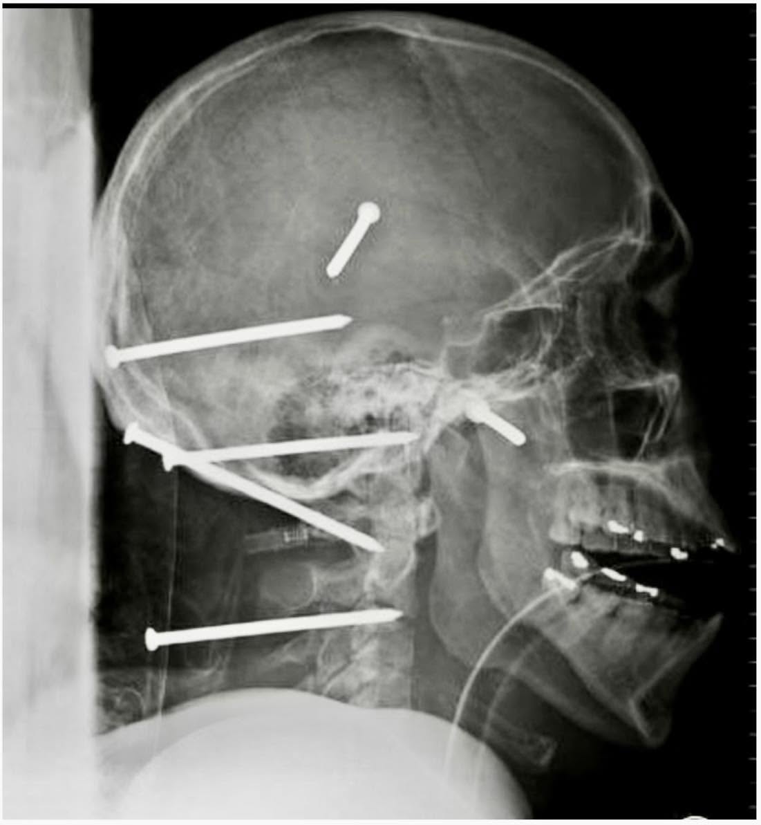 En 2026, un hospital en Los Ángeles vivió un momento asombroso cuando los médicos se toparon con una radiografía inusual: el cráneo de Isidro Mej...