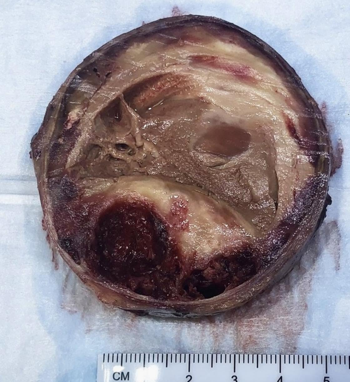 Un aneurisma arterial es una dilatación anormal en la pared de un vaso sanguíneo, similar a una burbuja