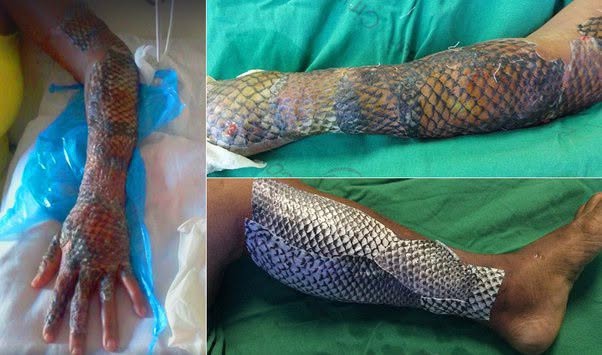 En los últimos años, una técnica médica poco común ha llamado la atención de investigadores y médicos: utilizar piel de pescado para tratar que...