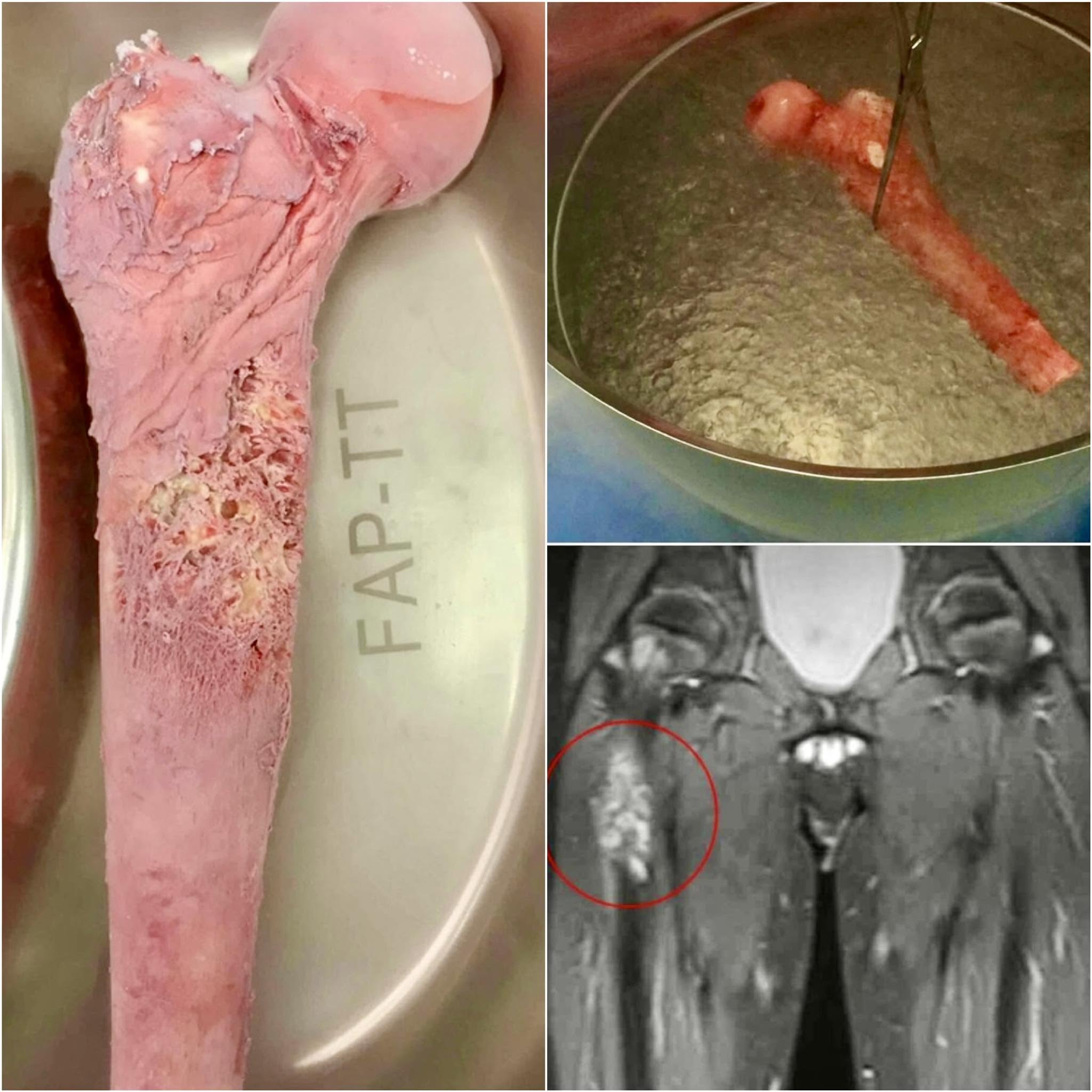 Lo que ves en la imagen es un fémur que pertenece a un niño de 10 años diagnosticado con sarcoma de Ewing, un tipo de cáncer que afecta principalm...