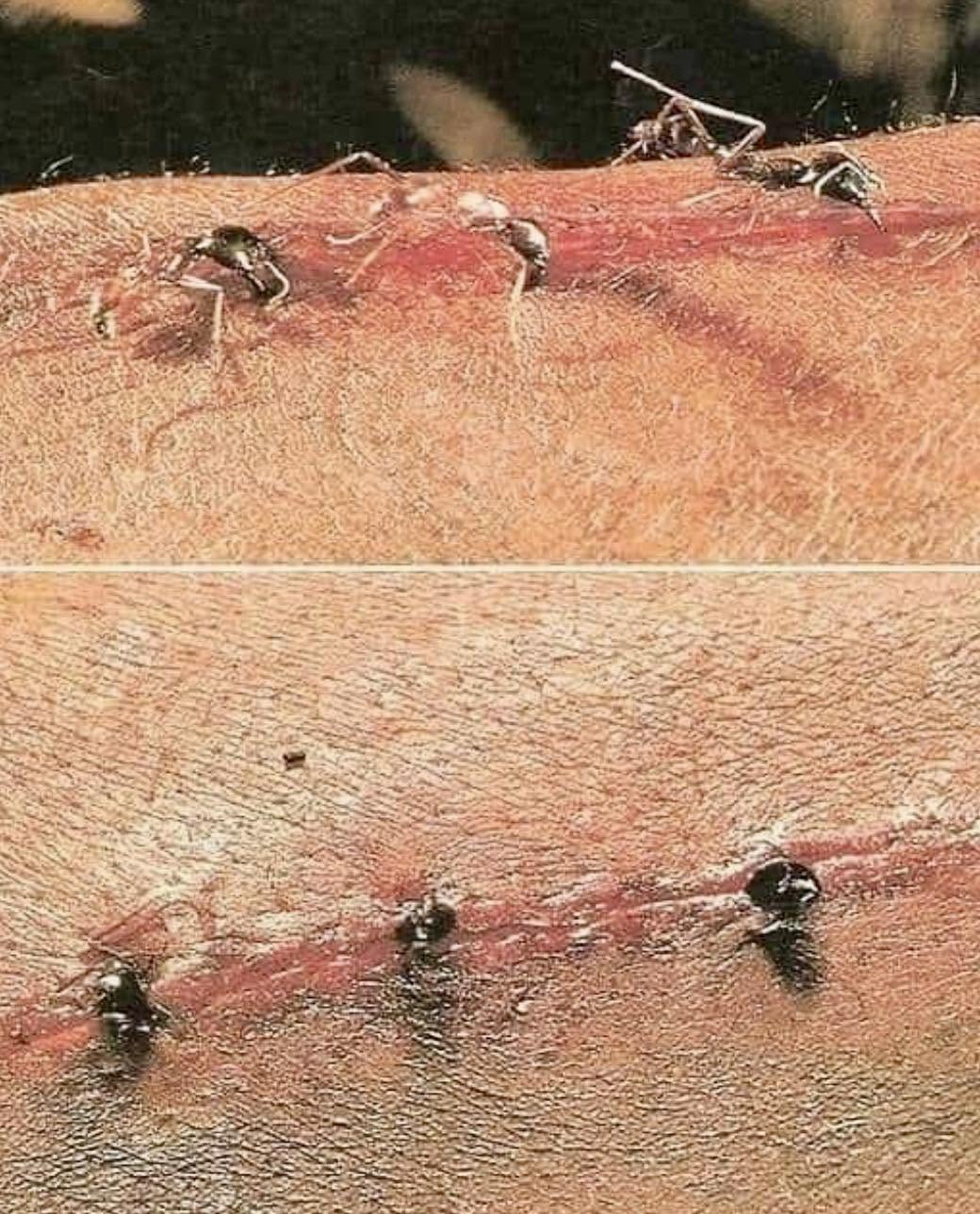En diversas regiones de África y Sudamérica, ciertas especies de hormigas son empleadas como suturas en procedimientos quirúrgicos