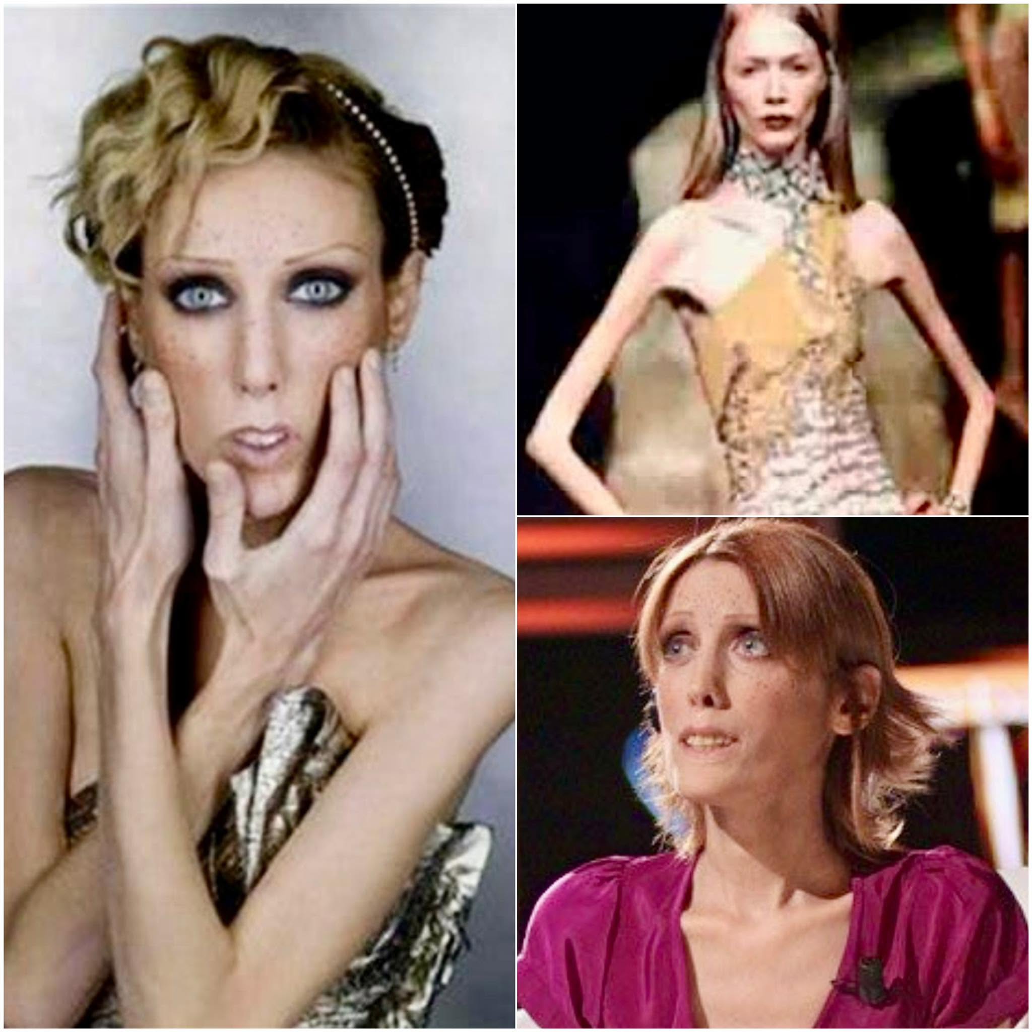Isabelle Caro, originaria de Francia, se convirtió en un símbolo trágico de la lucha contra la anorexia, una enfermedad que afecta a muchas persona...