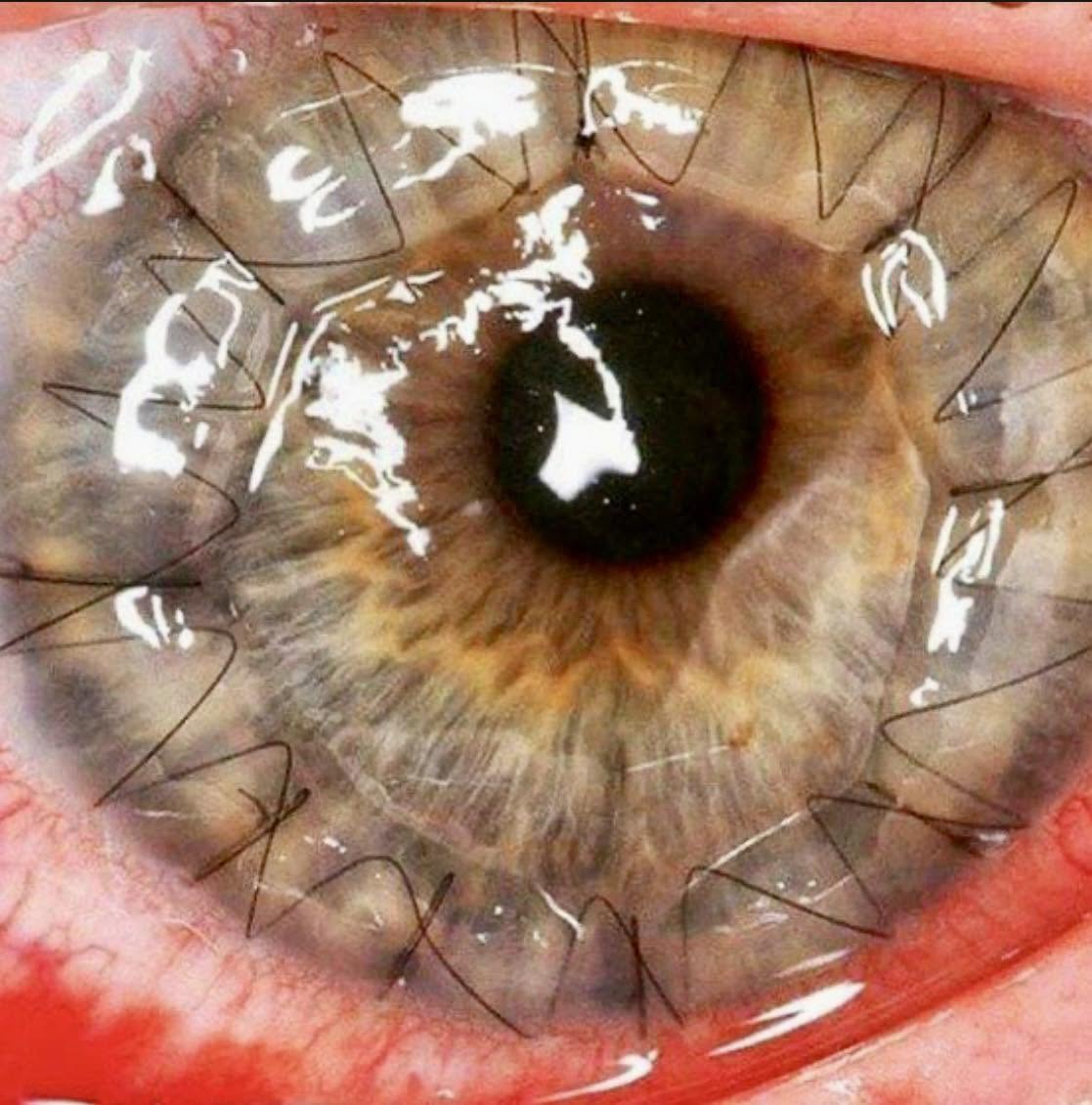 Así es como se ve el ojo cuando la córnea se cose después de una complicada cirugía