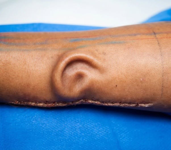 No le reconstruyeron solo una oreja