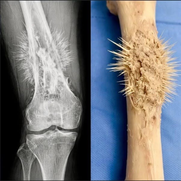 Esta es la apariencia en forma de rayos de sol del osteosarcoma, el cáncer óseo primario más común.