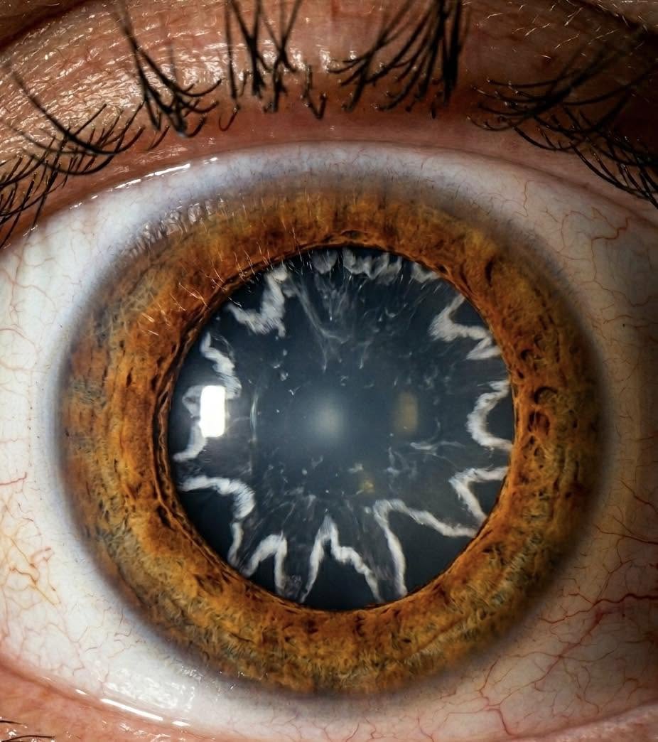 La ciencia médica rara vez nos regala imágenes tan impactantes como esta: estrellas grabadas en los ojos tras sobrevivir a una descarga de 14,000 vo...