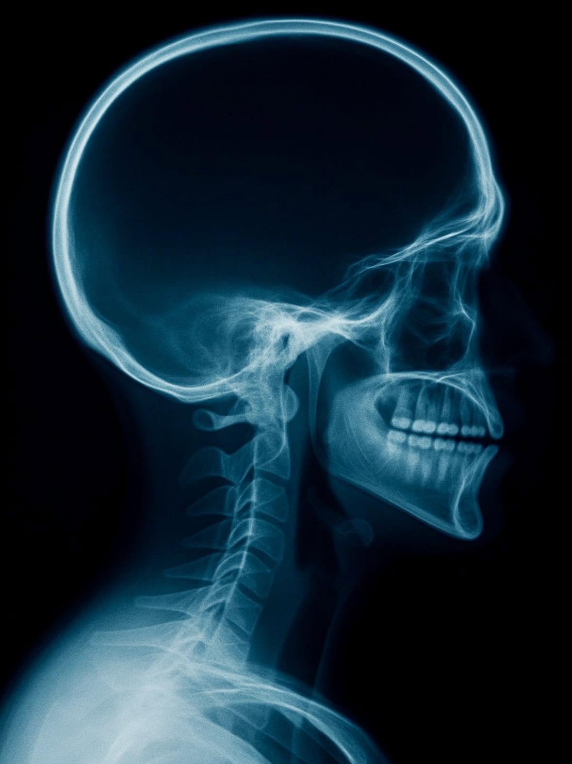 El hombre que vivía con el 10% de su cerebro: El caso que desafió a la ciencia