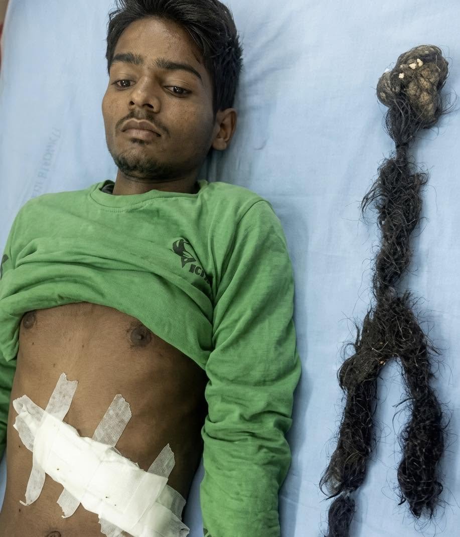 Narendra Kumar, un joven de 18 años originario de Uttar Pradesh, India, ingresó a un hospital tras meses de sufrir dolor abdominal crónico, pérdid...