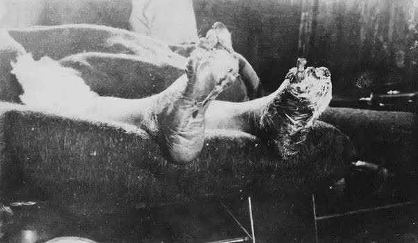 Durante la Primera Guerra Mundial, más de 74.000 soldados aliados sufrieron una devastadora afección conocida como "pie de trinchera"
