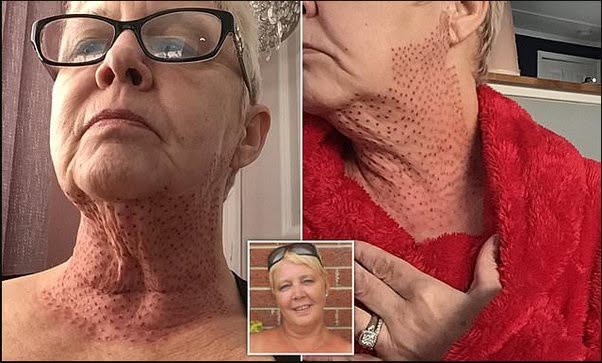 Una mujer quedó con el cuello deformado, como el de un lagarto, tras una intervención estética fallida