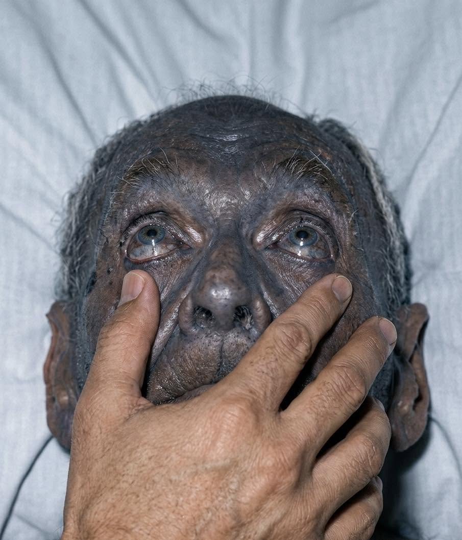 Esta fotografía parece sacada de un mito, pero es un registro real de uno de los fenómenos genéticos más extraños del mundo: la metahemoglobinemi...