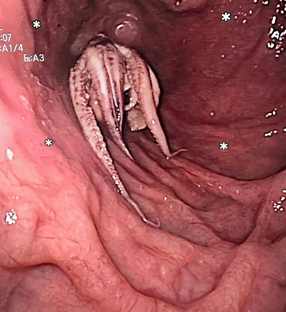Un caso médico real que parece sacado de una película de ficción sigue sorprendiendo por lo insólito de su naturaleza y la precisión con la que s...