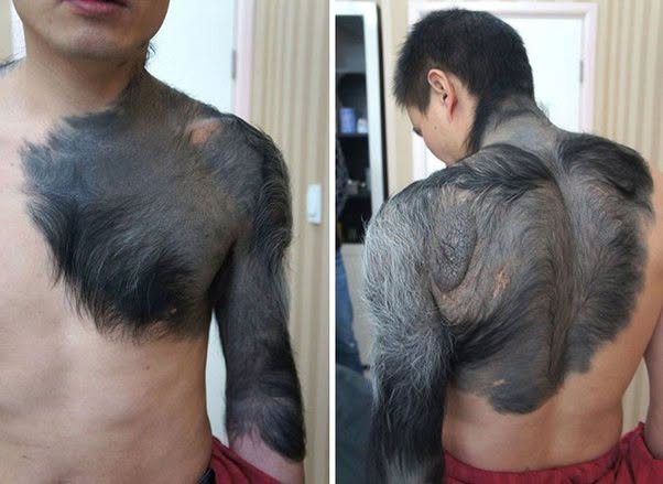 Zhang Hongming padece un raro nevo piloso pigmentado gigante congénito