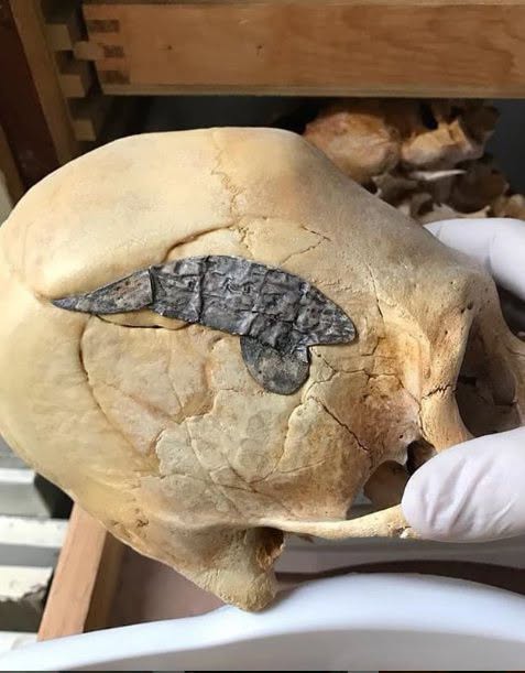 Un cráneo peruano alargado con implantes metálicos quirúrgicos tras su regreso de la batalla, con una antigüedad estimada de unos 2.000 años