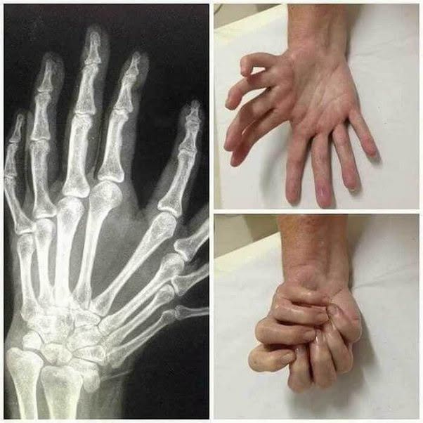 Esta foto parece un montaje, pero en realidad se trata de una afección genética muy rara llamada síndrome de la mano en espejo