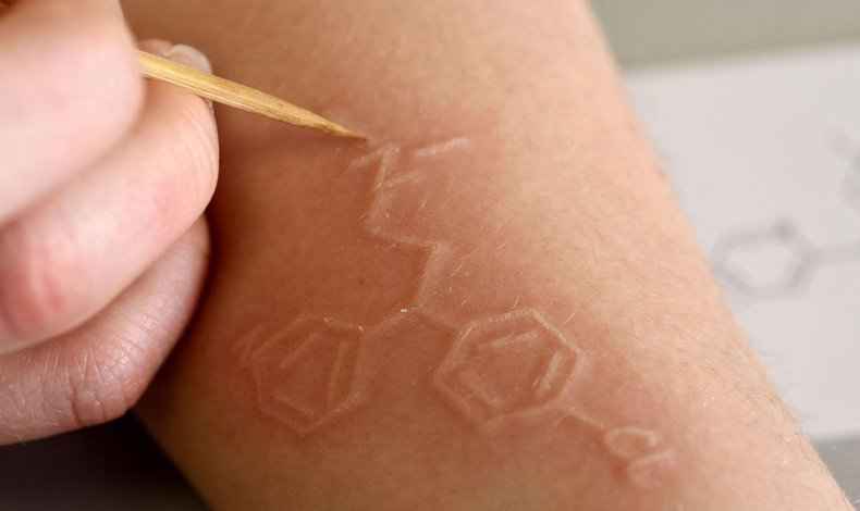 Dermatografía: Cuando la piel escribe sus propias marcas