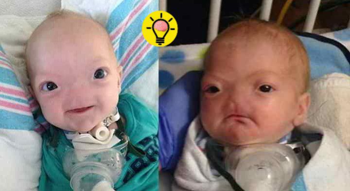 El bebé milagro que nació sin nariz: conoce la rara arhinia congénita