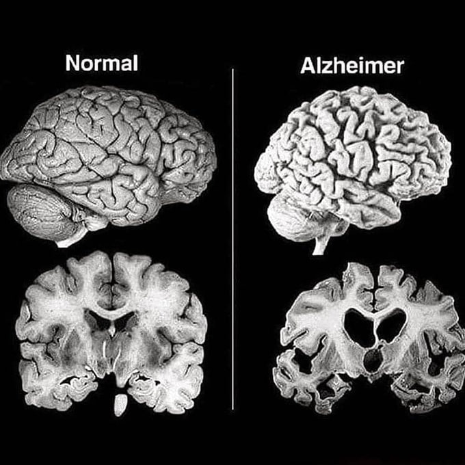 Alzhéimer: Cómo el cerebro se encoge y pierde funciones vitales
