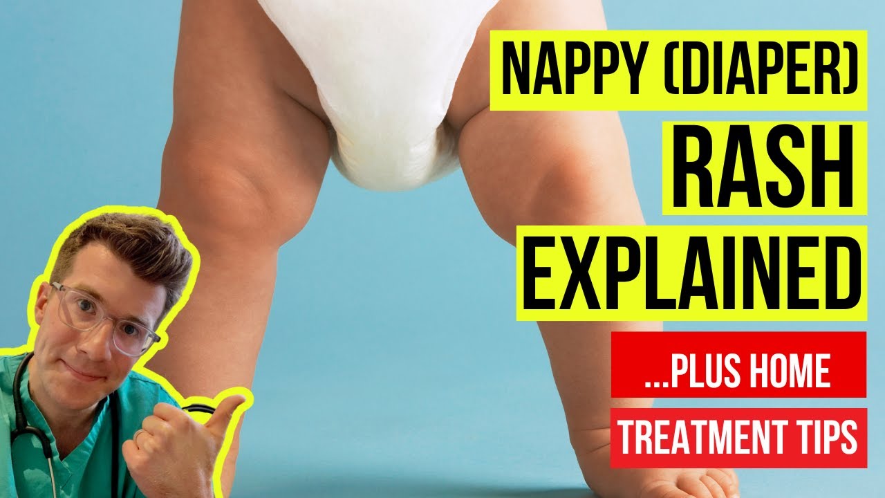 Causes of Nappy Rash & How to Treat Nappy Rash