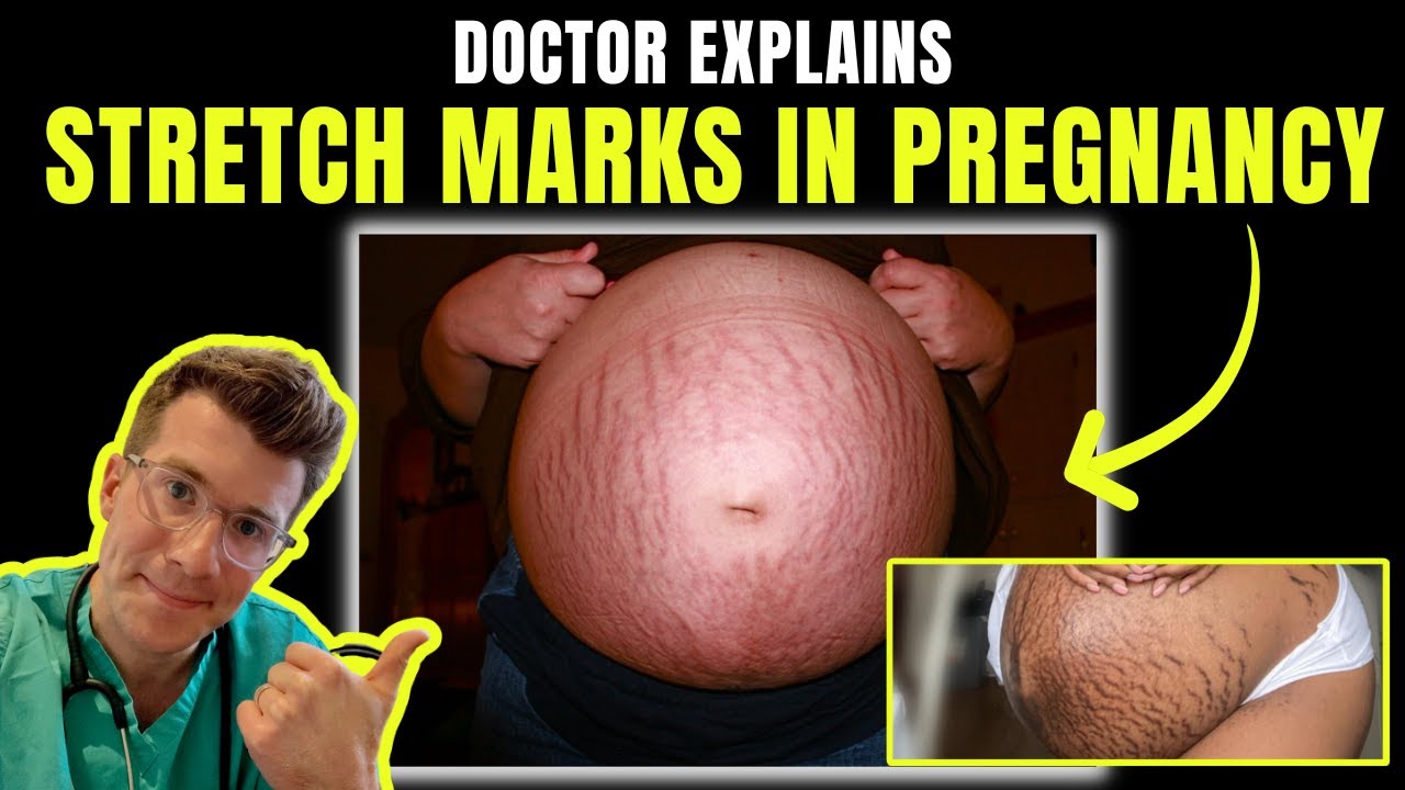 How to Prevent And Treat Pregnancy Stretch Marks & Tips to Prevent Stretch Marks During Pregnancy