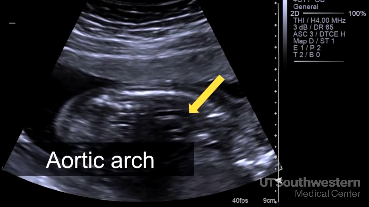 How To Read Fetal Ultrasound Reports